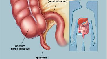 What is Appendicitis and why it occurs