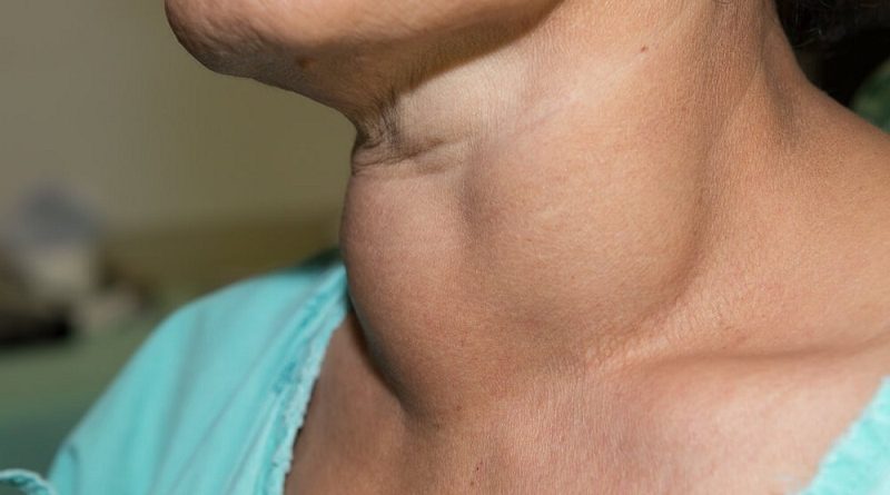 Lipoma in the neck