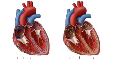 ATRIAL FLUTTER: SYMPTOMS, DIAGNOSIS AND ECG, THERAPY
