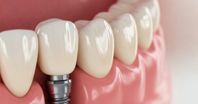 How long does a dental implant last